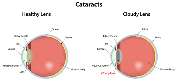 Example of a cataract